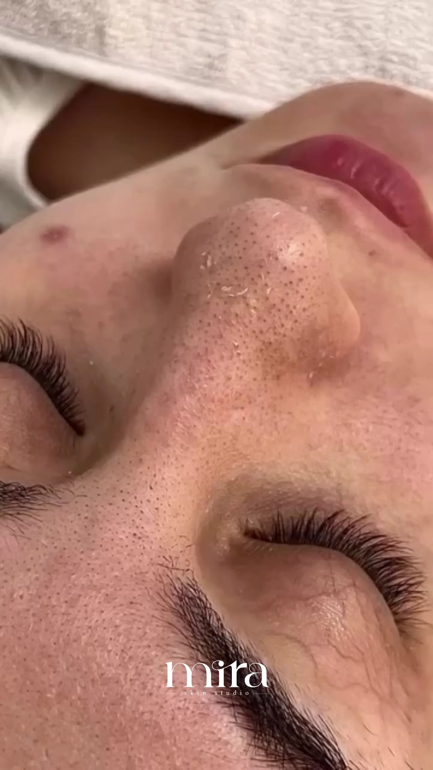فیشال تخصصی و جوانسازی میرا