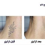 ریمو تتو با لیزر