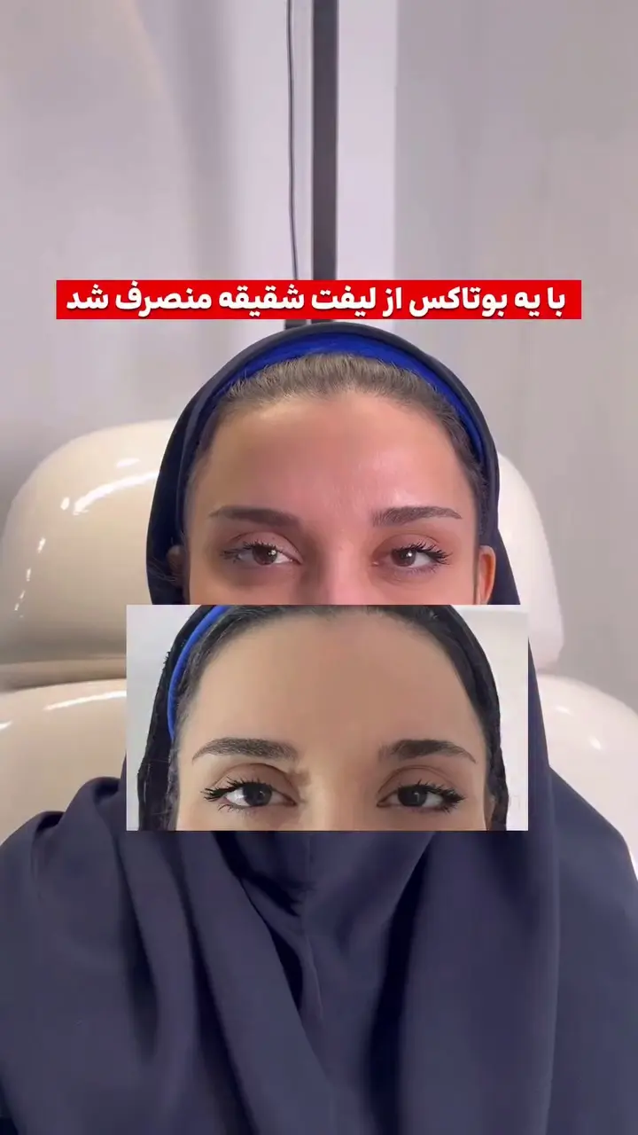 کلینیک تخصصی زیبایی رز - فیلر بوتاکس