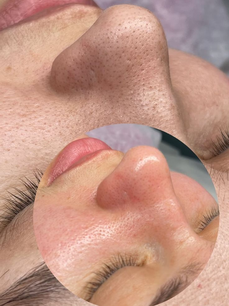 فیشال و پاکسازی پوست زرمالی