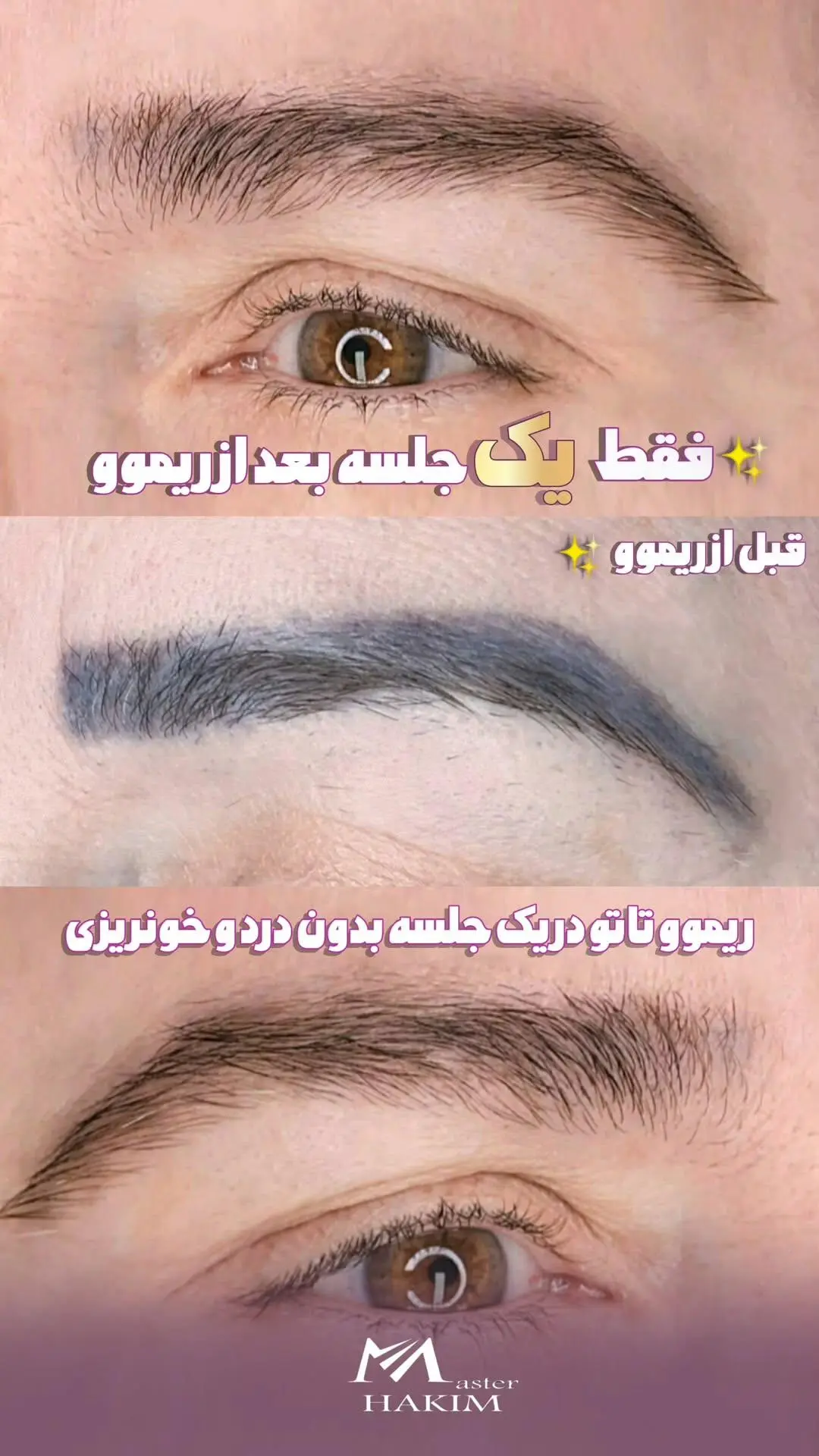 ریموو تاتو